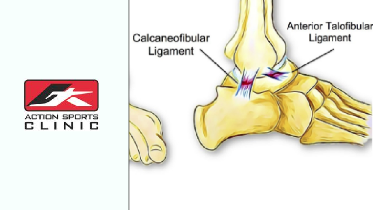 Chronic Ankle Instability